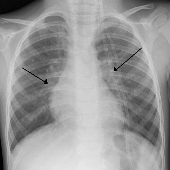An X-ray image of a child's ribcage with two black arrows pointing toward white masses